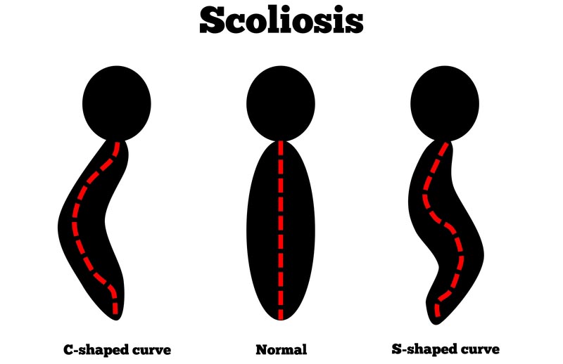 Zapopan, Jal scoliosis treatment